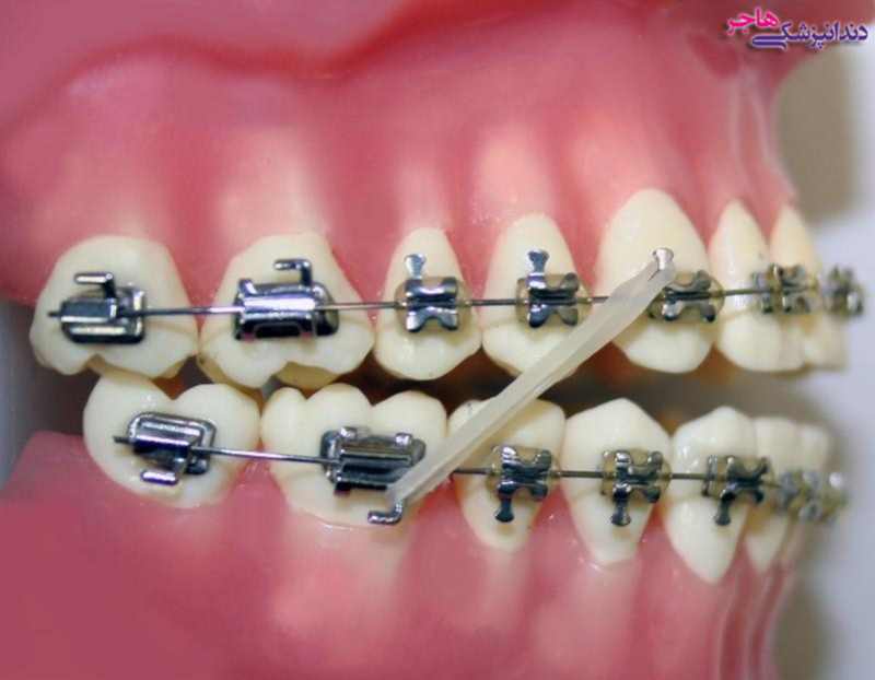 کش یا الاستیک باعث حرکت دندانهای دو طرف آن به سمت یکدیگر میشود